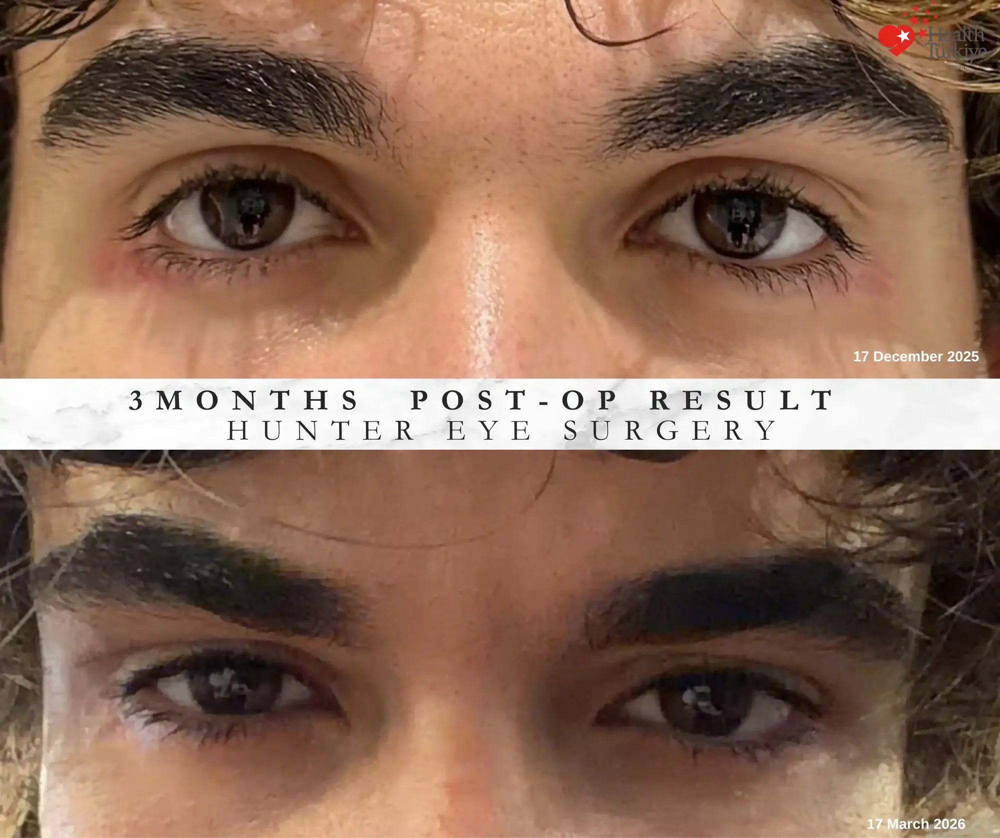 hunter eye surgery 3 month result