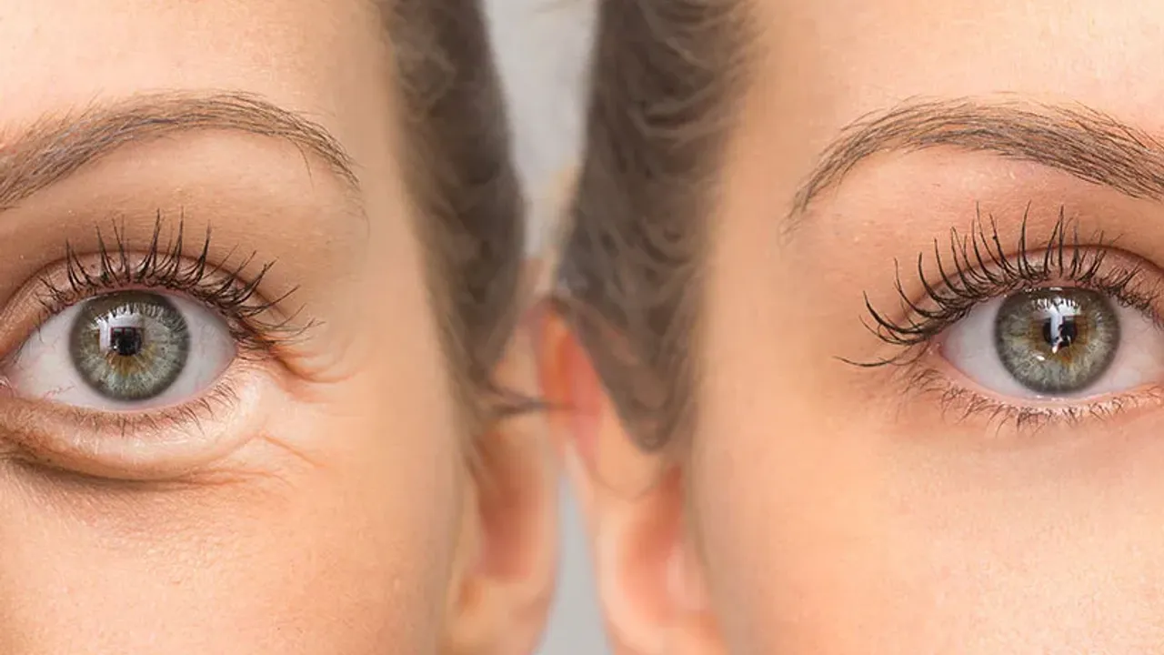 Transkonjonktival Blefaroplasti