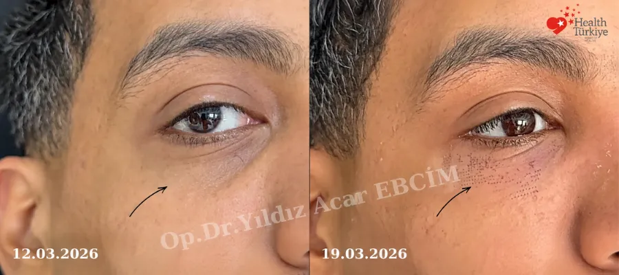 infraorbital rim implant ameliyatı
